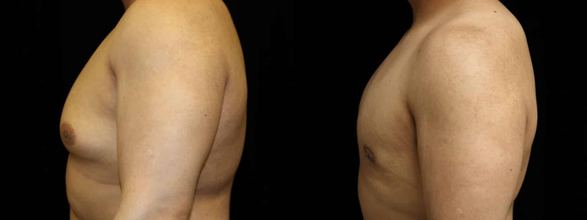 Gynecomastia Patient 3 Before & After Details