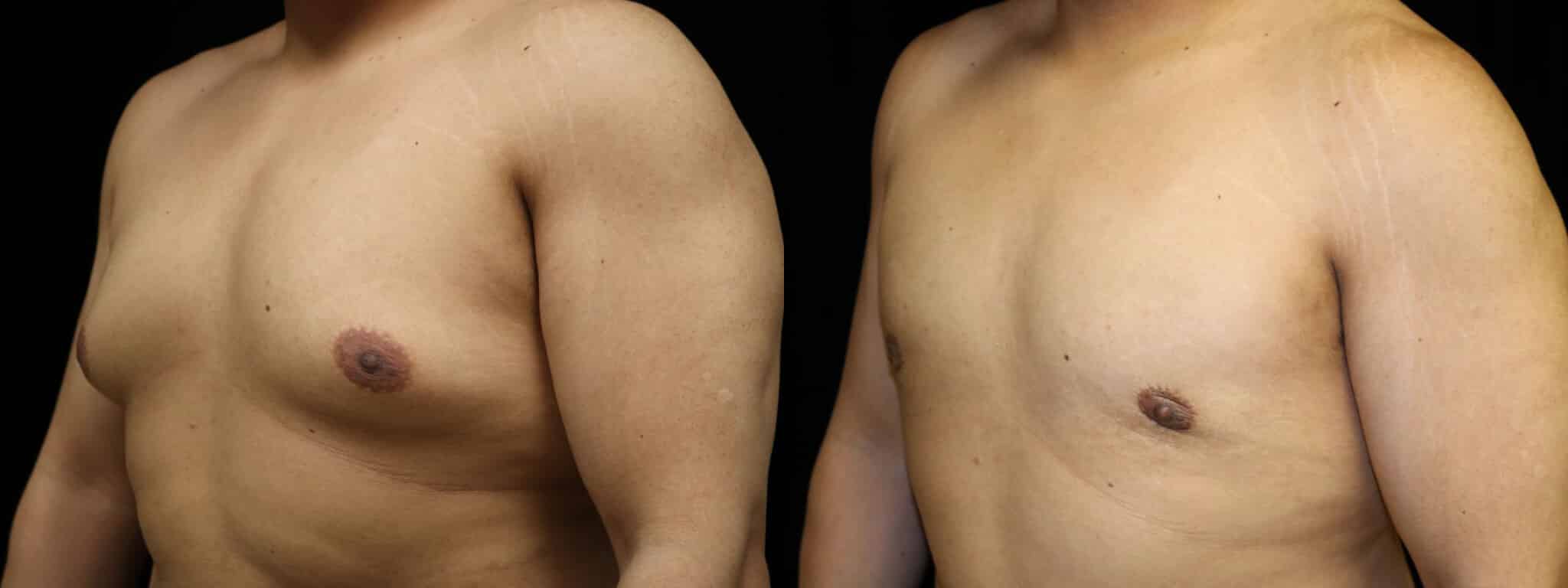 Gynecomastia Patient 3 Before & After Details