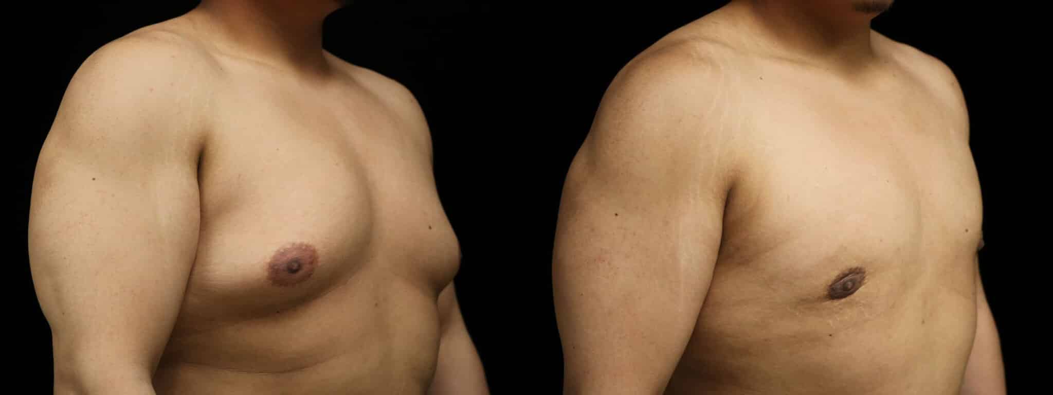 Gynecomastia Patient 3 Before & After Details