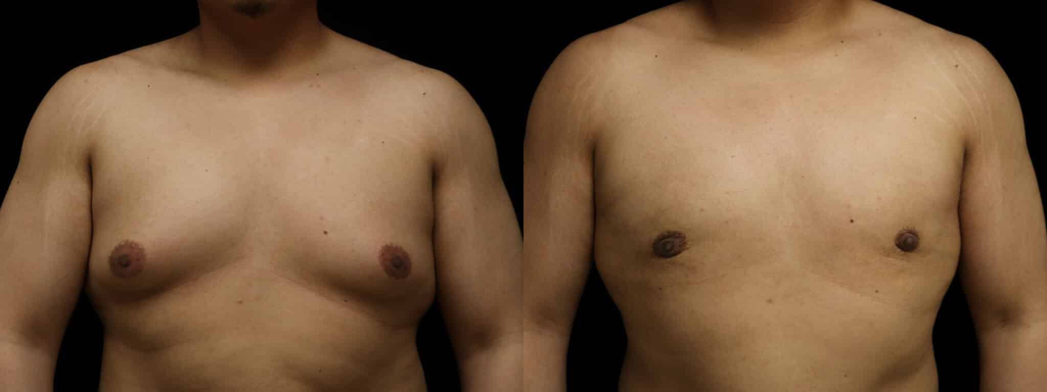 Gynecomastia Patient 3 Before & After