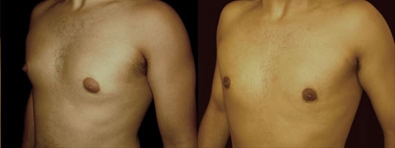 Gynecomastia Patient 14 Before & After Details