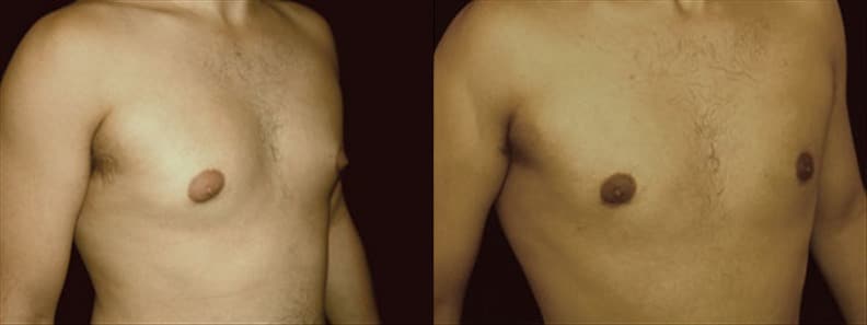 Gynecomastia Patient 14 Before & After Details