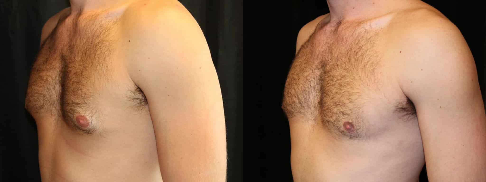 Gynecomastia Patient 7 Before & After Details