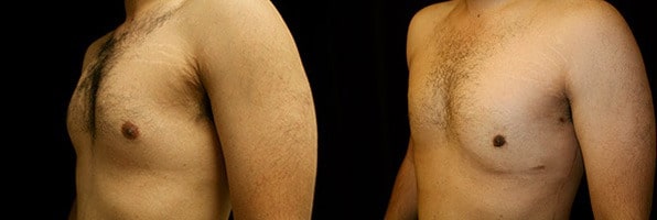 Gynecomastia Patient 11 Before & After Details