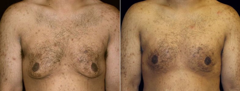 Gynecomastia Patient 13 Before & After