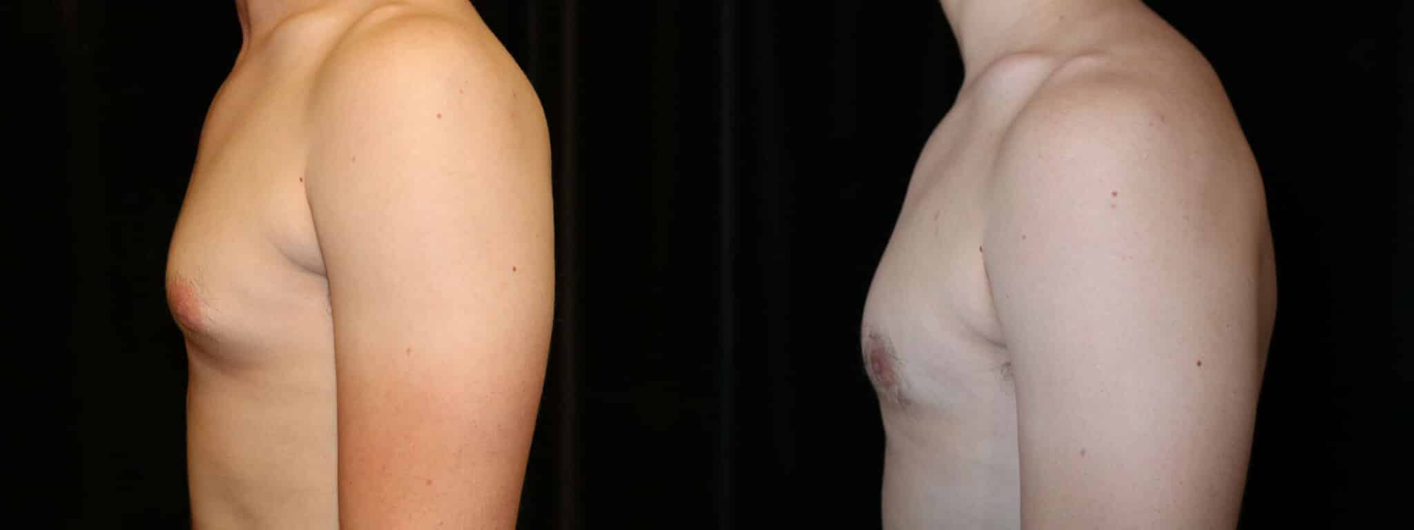 Gynecomastia Patient 17 Before & After Details