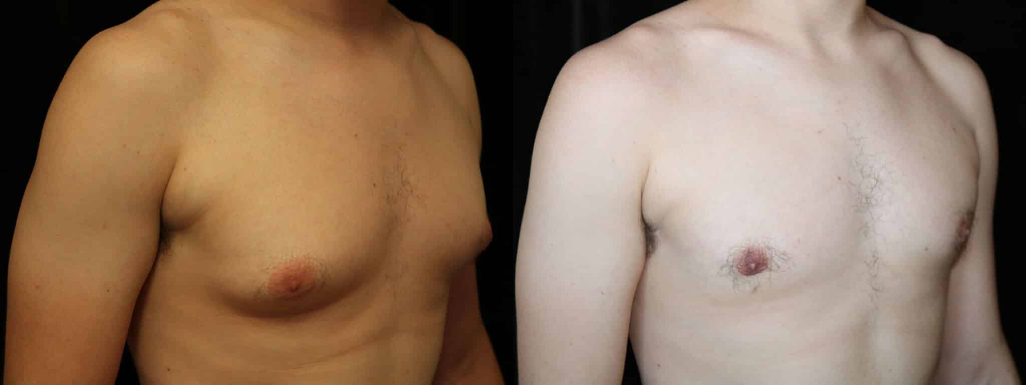 Gynecomastia Patient 17 Before & After Details