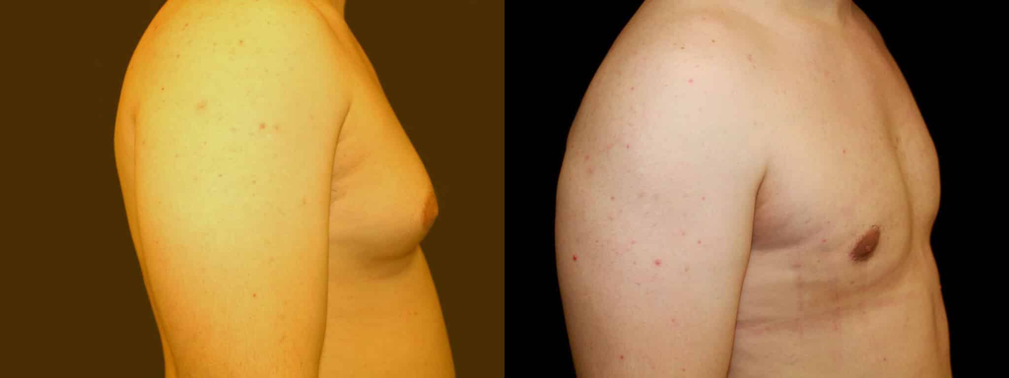 Gynecomastia Patient 5 Before & After Details