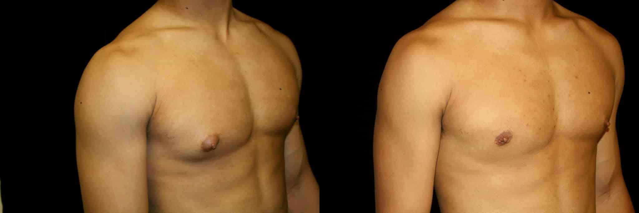 Gynecomastia Patient 15 Before & After Details