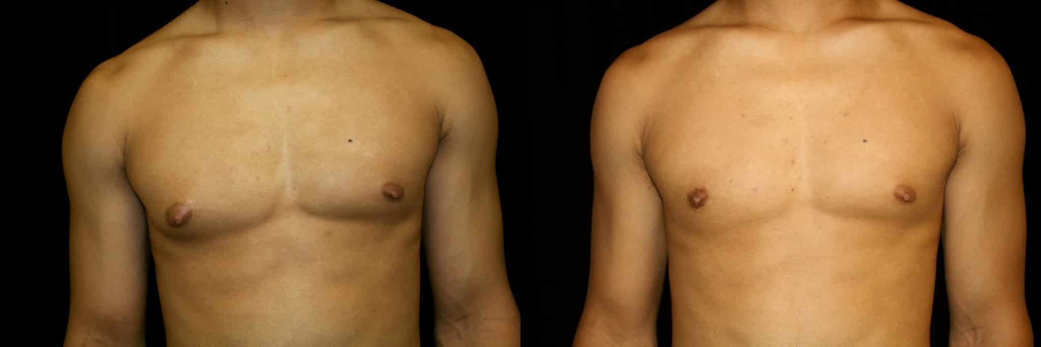 Gynecomastia Patient 15 Before & After