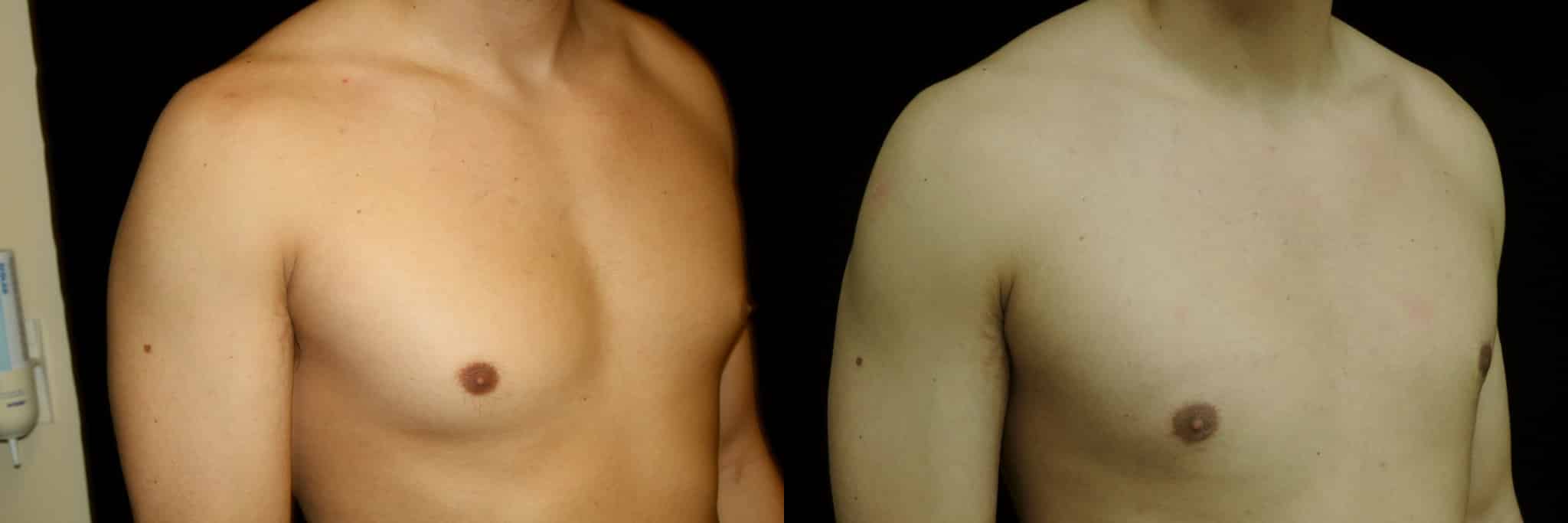 Gynecomastia Patient 18 Before & After Details