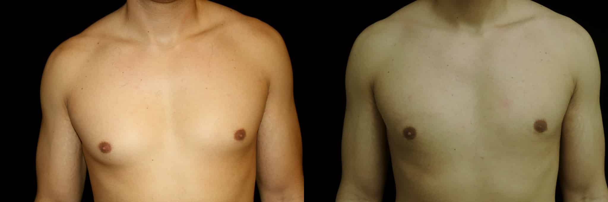 Gynecomastia Patient 18 Before & After