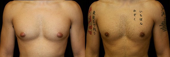 Gynecomastia Patient 11 Before & After