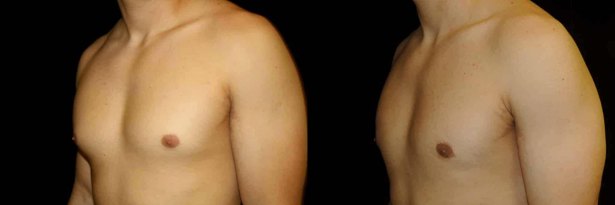 Gynecomastia Patient 18 Before & After Details