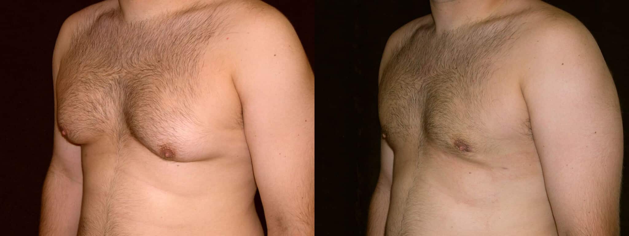 Gynecomastia Patient 8 Before & After Details