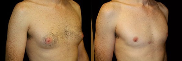Gynecomastia Patient 12 Before & After Details