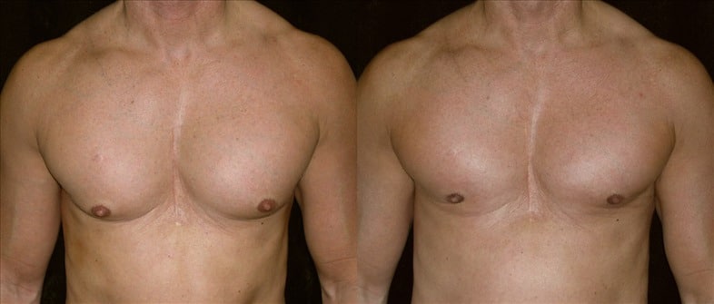 Gynecomastia Patient 2 Before & After