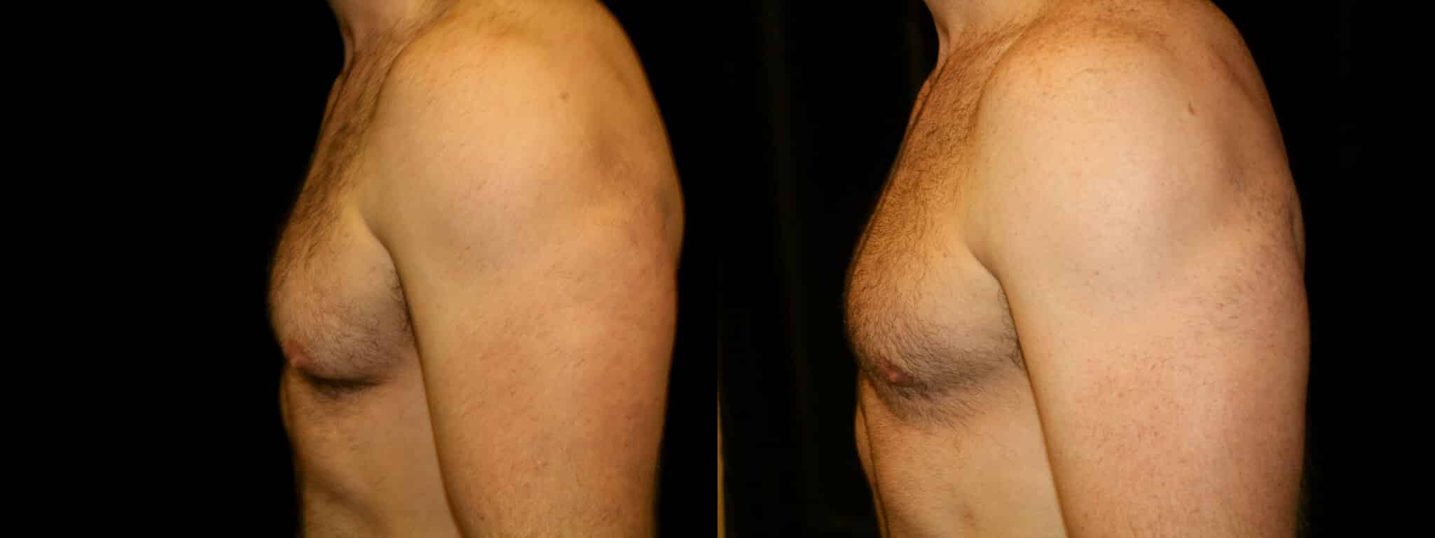 Gynecomastia Patient 8 Before & After Details