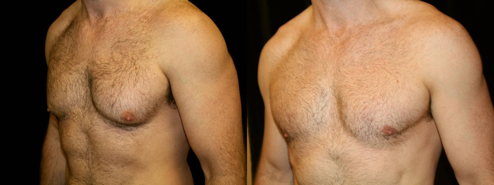 Gynecomastia Patient 8 Before & After Details