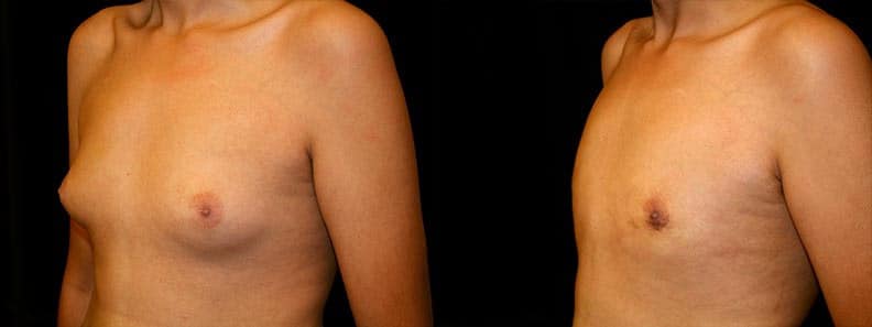 Gynecomastia Patient 17 Before & After Details