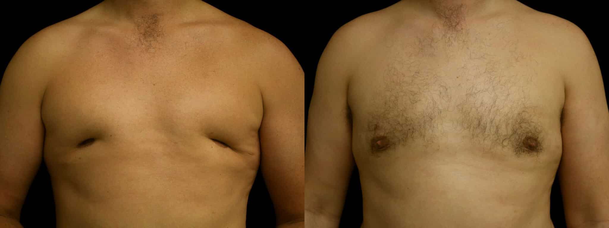 Gynecomastia Patient 9 Before & After