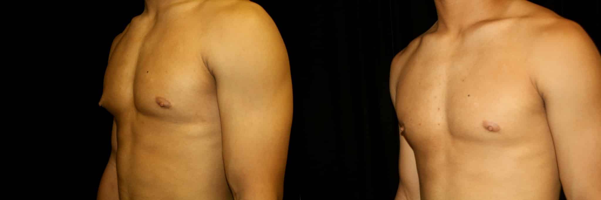 Gynecomastia Patient 15 Before & After Details