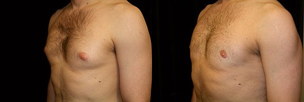 Gynecomastia Patient 17 Before & After Details