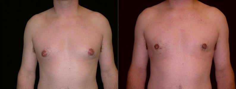 Gynecomastia Patient 12 Before & After