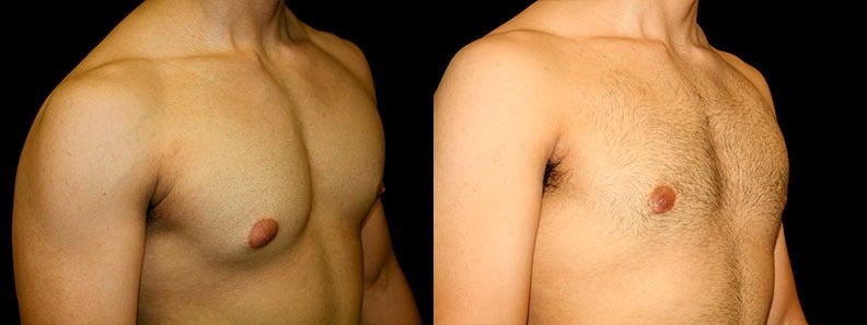 Gynecomastia Patient 14 Before & After Details