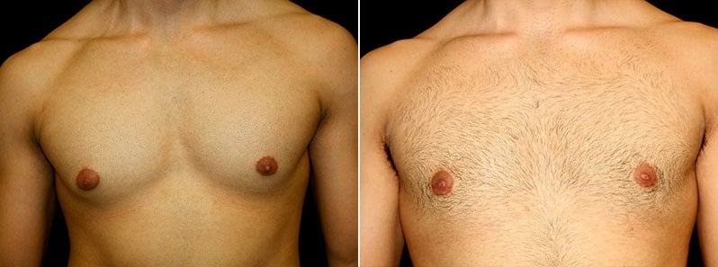 Gynecomastia Patient 14 Before & After