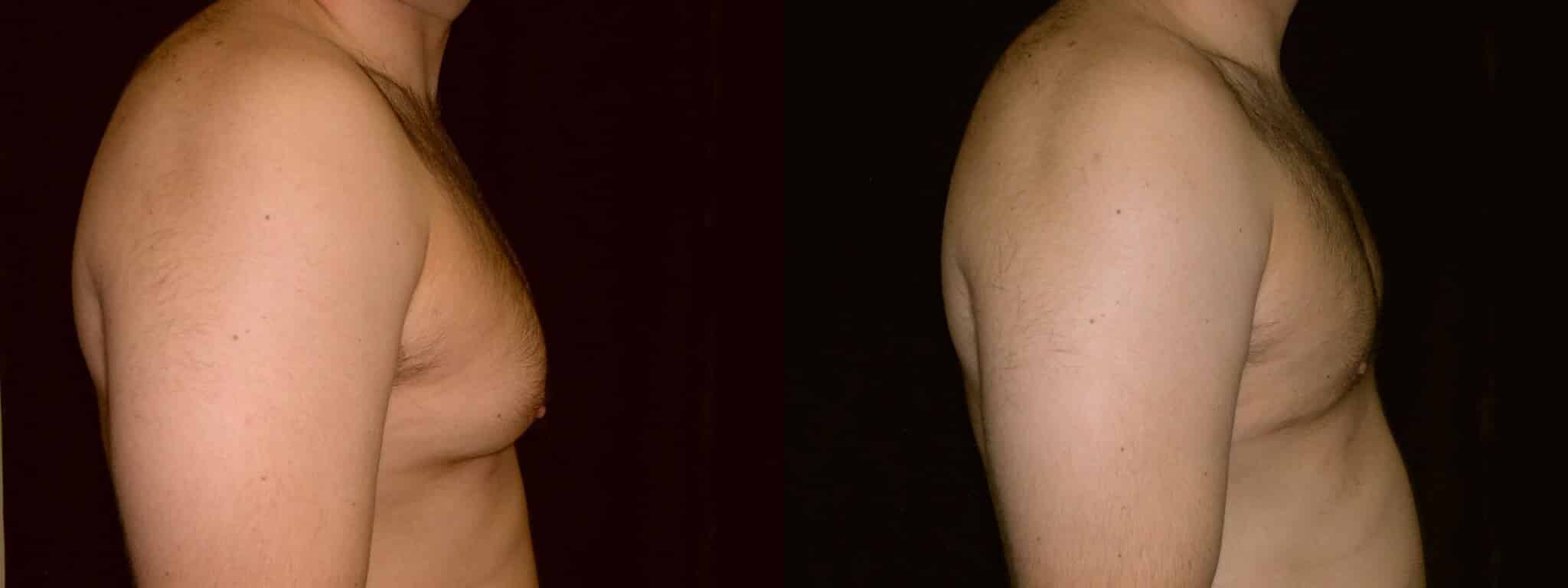 Gynecomastia Patient 8 Before & After Details