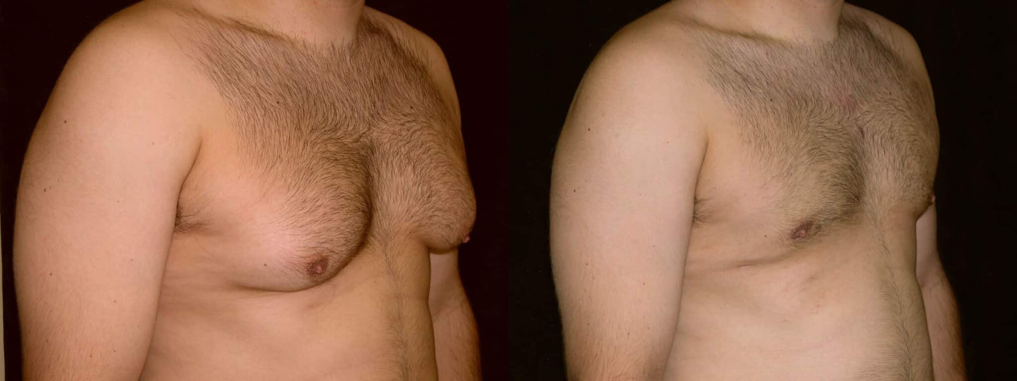 Gynecomastia Patient 8 Before & After Details