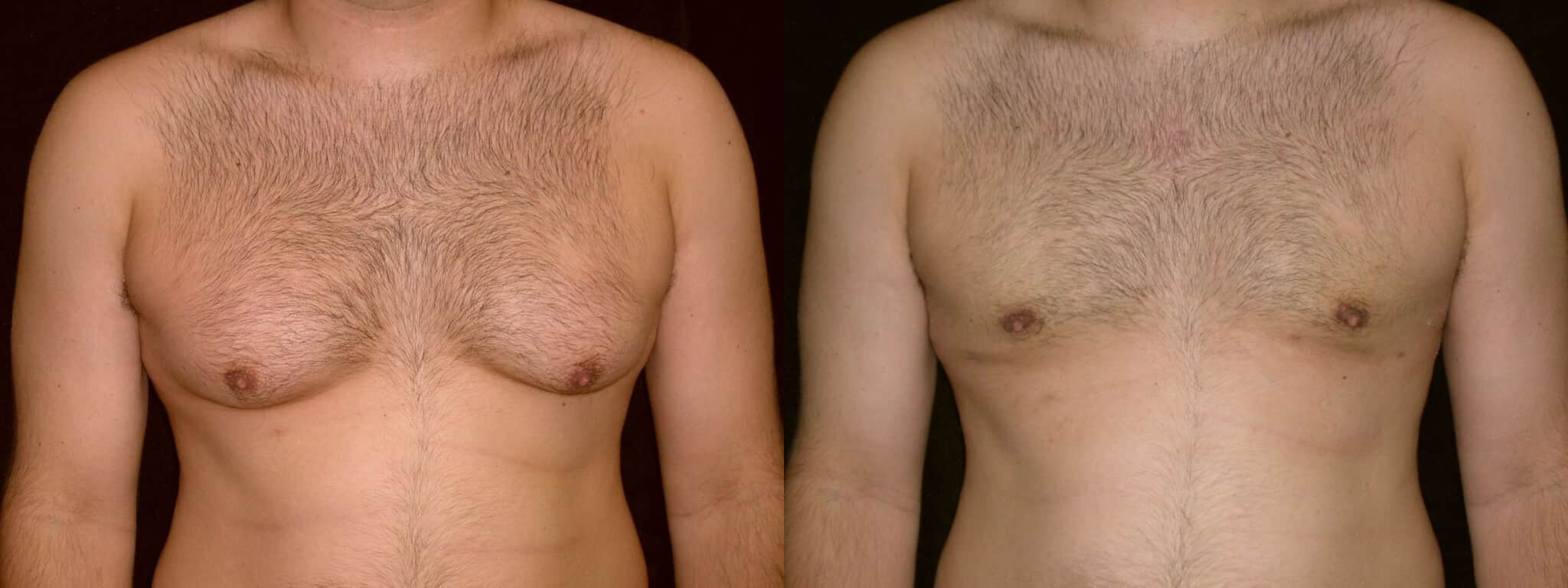 Gynecomastia Patient 8 Before & After
