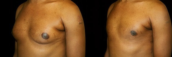 Gynecomastia Patient 10 Before & After Details