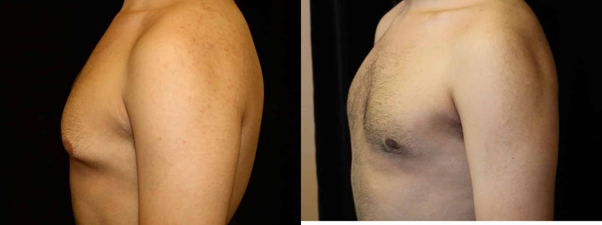 Gynecomastia Patient 13 Before & After Details