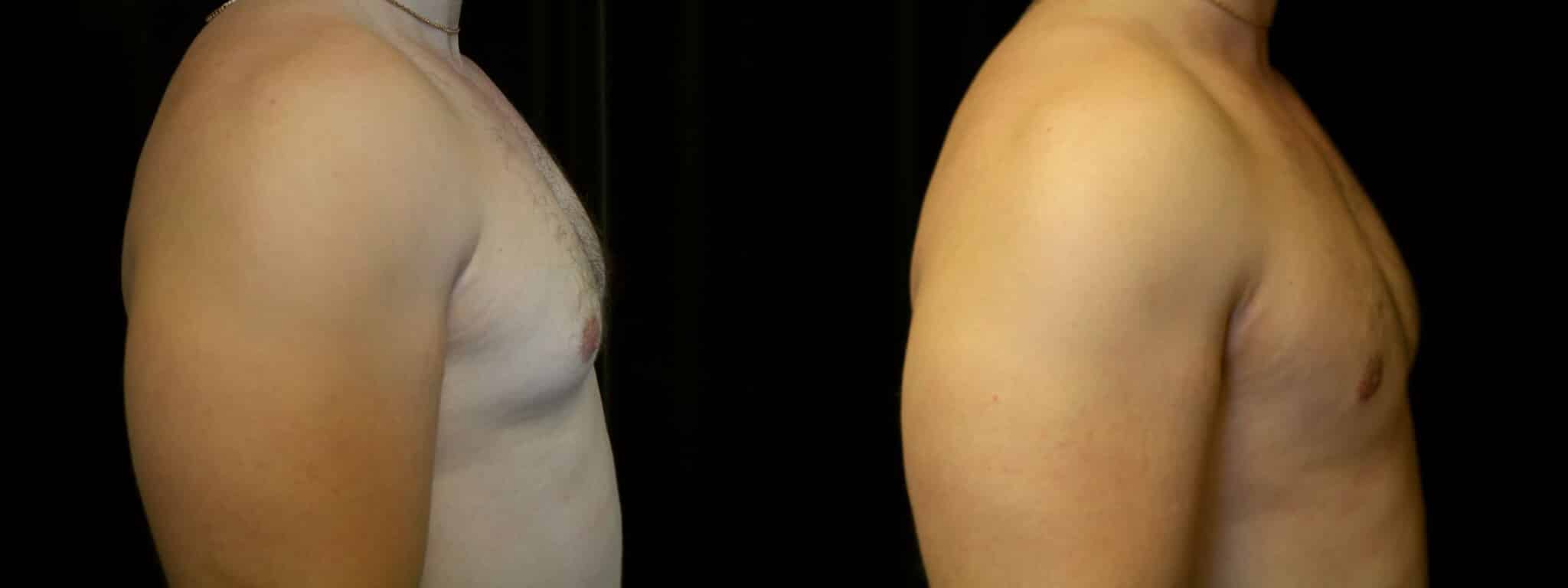 Gynecomastia Patient 16 Before & After Details