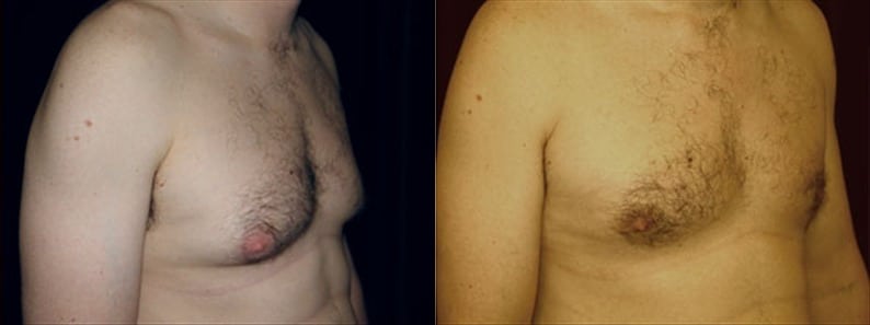 Gynecomastia Patient 8 Before & After Details