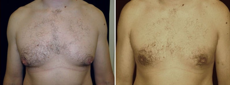 Gynecomastia Patient 8 Before & After