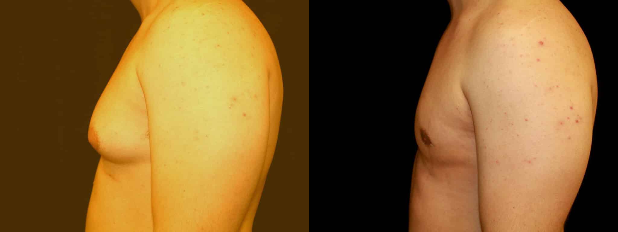 Gynecomastia Patient 5 Before & After Details