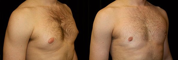 Gynecomastia Patient 17 Before & After Details