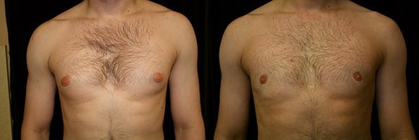 Gynecomastia Patient 17 Before & After