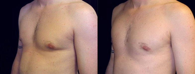 Gynecomastia Patient 10 Before & After