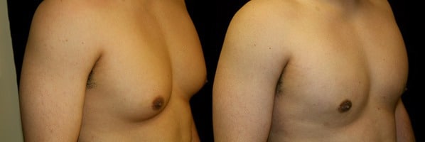 Gynecomastia Patient 18 Before & After Details