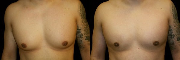 Gynecomastia Patient 18 Before & After