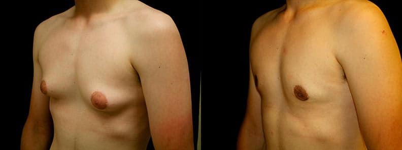 Gynecomastia Patient 2 Before & After Details