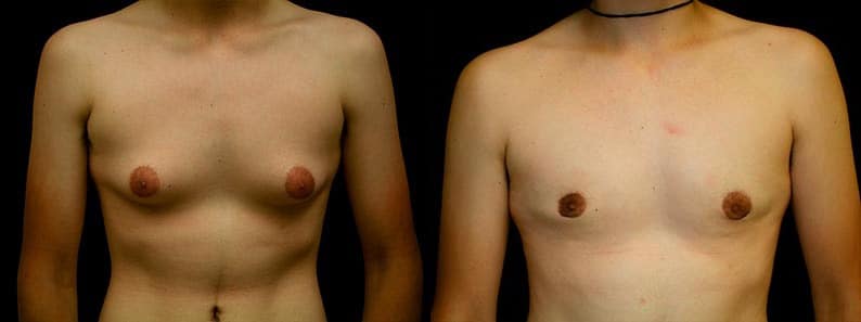 Gynecomastia Patient 2 Before & After