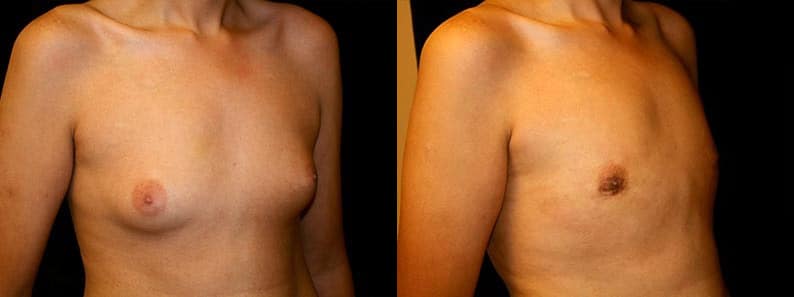 Gynecomastia Patient 17 Before & After Details