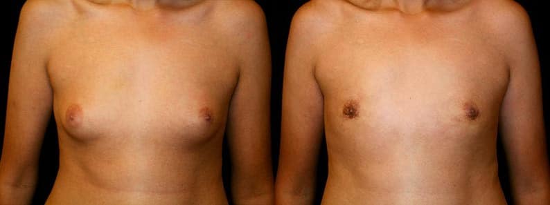 Gynecomastia Patient 17 Before & After