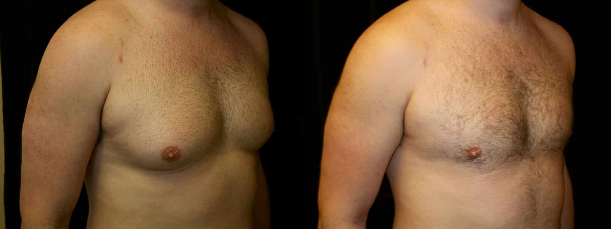Gynecomastia Patient 14 Before & After Details