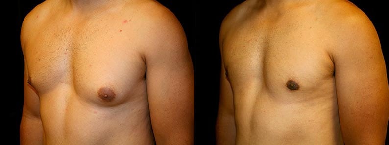 Gynecomastia Patient 20 Before & After Details